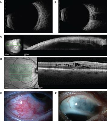 Scleritis in rheumatoid arthritis: Before and during biologic era
